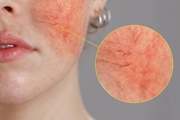 Triggerfaktorer for Rosacea