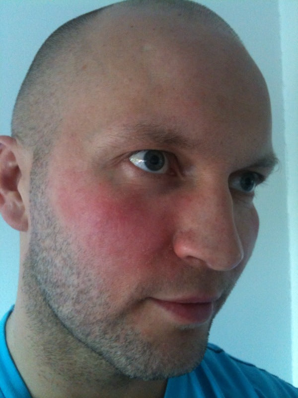 Reaksjon på medikamenter