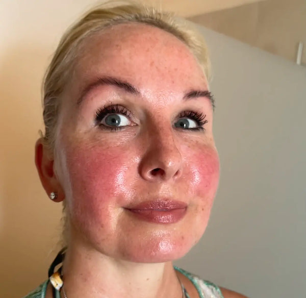 Rosacea i VG onsdag 12. september