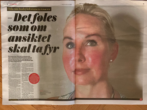 Rosacea i VG fredag 18 august